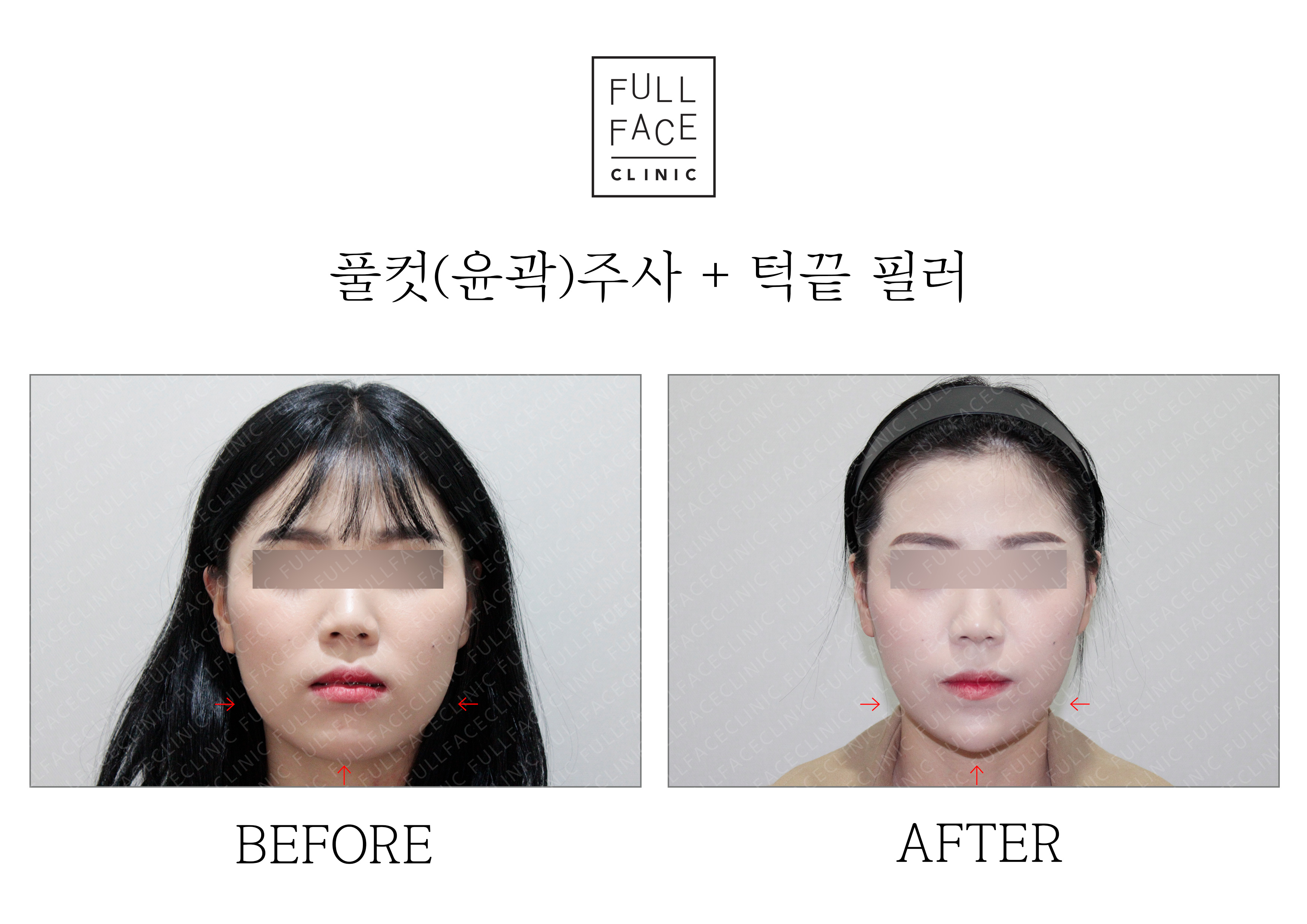 Before/After