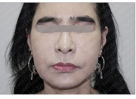 Special-Area & Body Fillers After