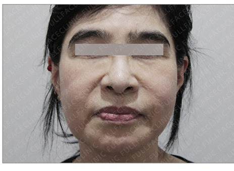 Special-Area & Body Fillers Before