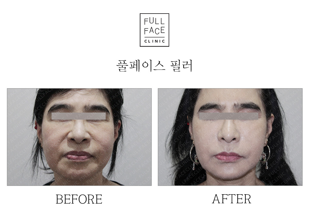 Before/After