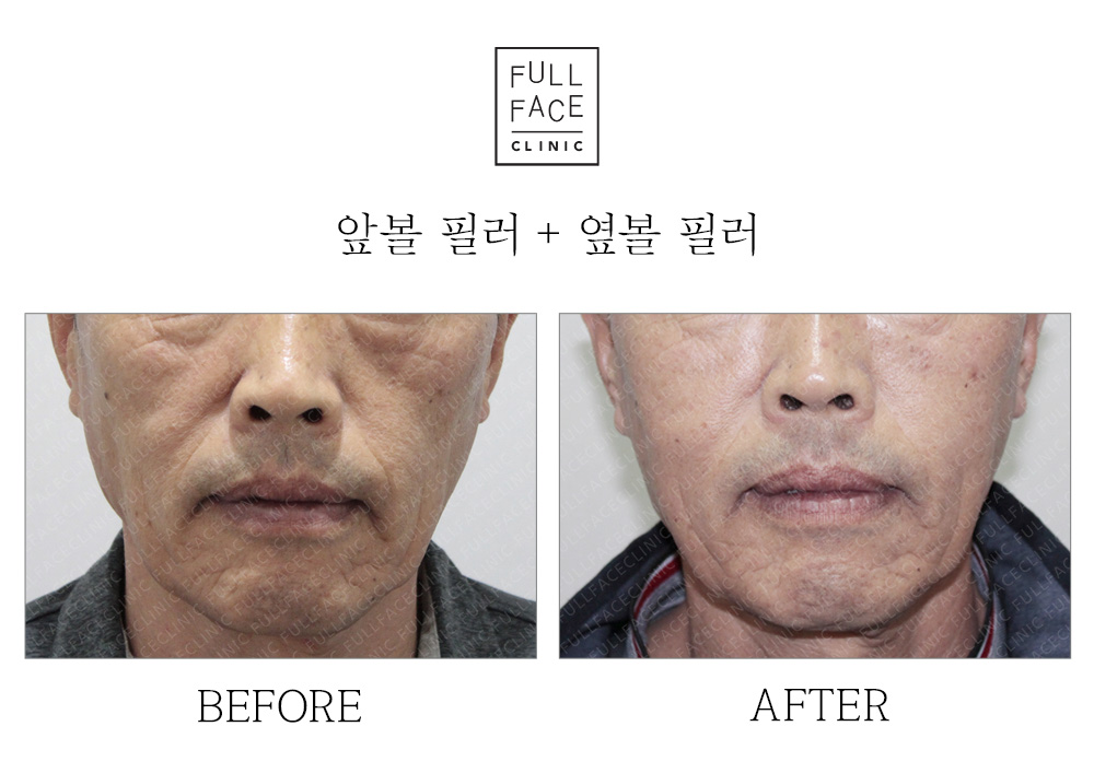 Before/After