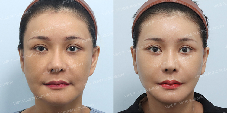 #Face Lift(Revision) #Prominent-ear Correction