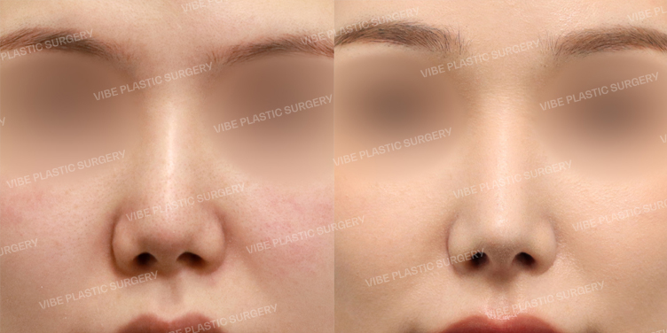 #Rhinoplasty Revision #Nasal Bridge #Nose Tip #Autologous Rib #Pinched Nose #Short Nose #Nasolabial-angle Correction