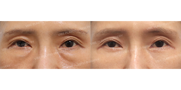 #Lower Blepharoplasty