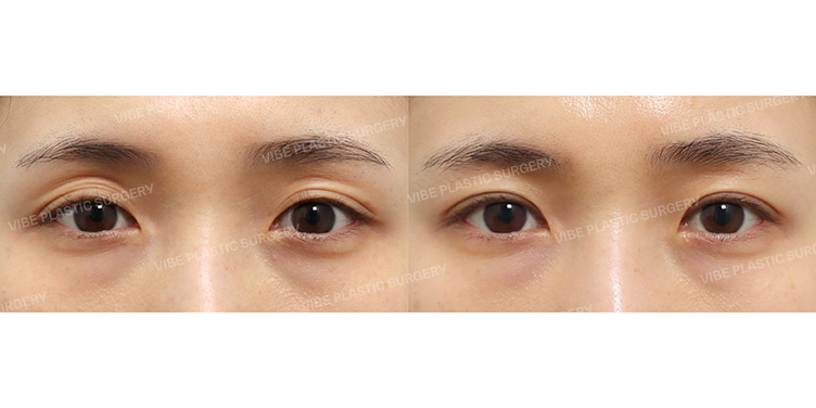#Incisional Ptosis Correction #Upper-eyelid Fat Repositioning
