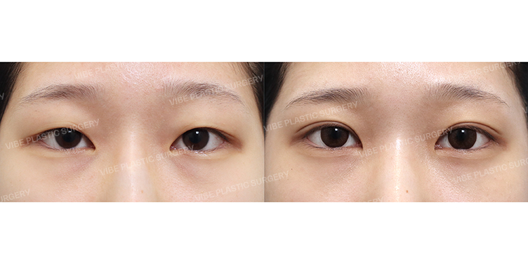 #Partial-incision Double Eyelid #Upper Canthoplasty