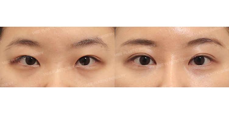 #Partial-incision Ptosis Correction #Medial Epicanthoplasty