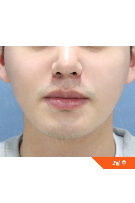 After