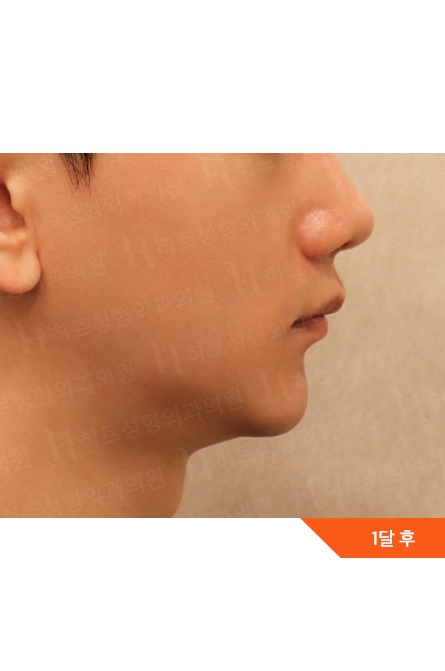 Facial Contouring After