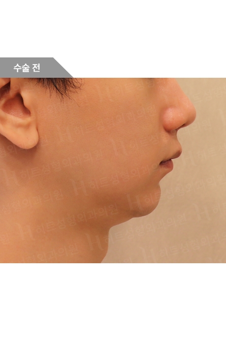 Facial Contouring Before