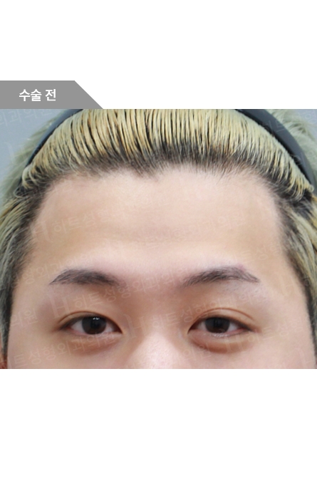 Before