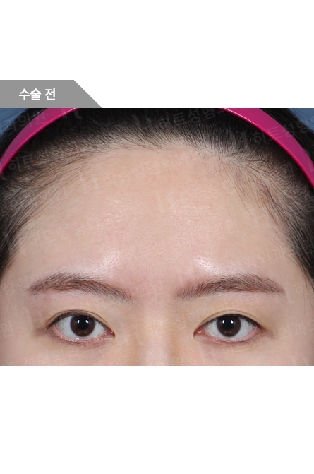 Before