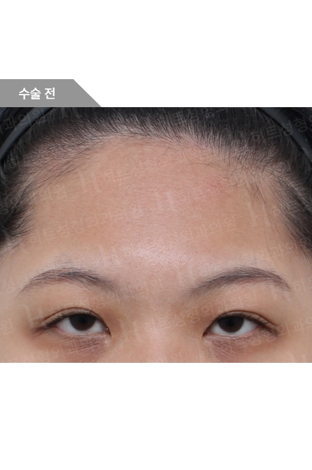 Before