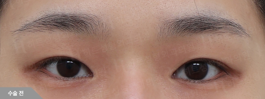 Before