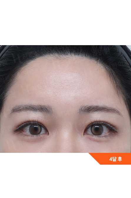 Eye Surgery After