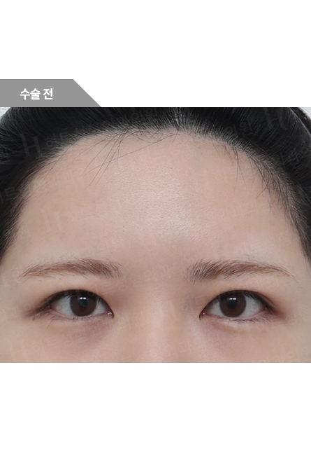 Eye Surgery Before