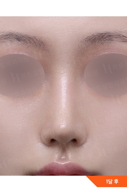 Rhinoplasty After