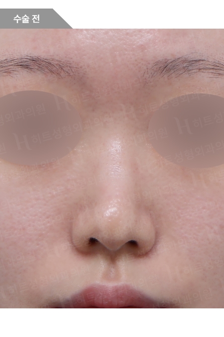 Rhinoplasty Before